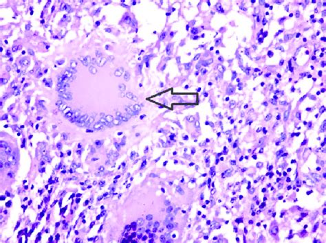 Biopsy Histology A Necrotising Granulomatous Inflammation Granuloma