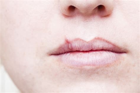 Do Cold Sores Happen On Lips | Lipstutorial.org