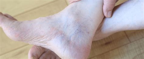 How Do Varicose Veins Develop On The Ankles