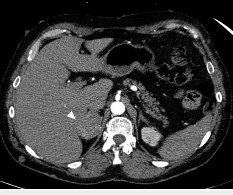 Axial Contrast Enhanced Ct Of The Upper Abdomen Showing The
