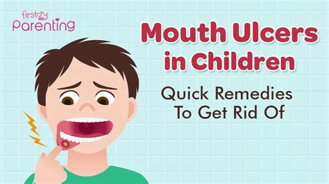 Mouth Ulcers Canker Sores In Children Causes Symptoms And Treatment
