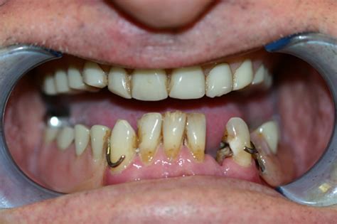 First Immediate Dentures