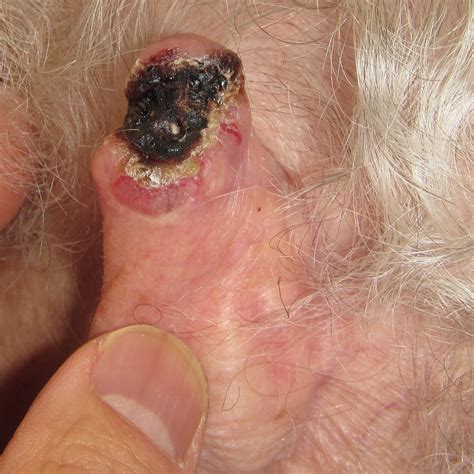 Skincancerphysician Skin Cancer Squamous Cell Carcinoma