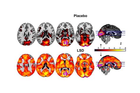 First LSD brain imaging study offers insights into consciousness | New 