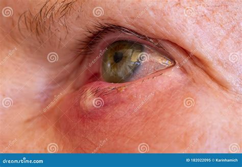 Closeup Of Man Eye With Stye Purging Pus With Doctor Finger With Blue