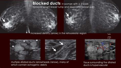 Breast Duct Ectasia Us Mammogram Mri