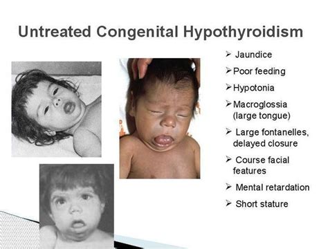 Hypothyroidism In Infants Medizzy