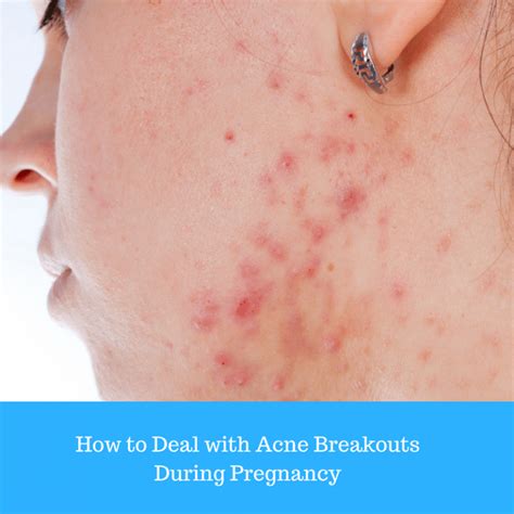 How To Deal With Acne Breakouts During Pregnancy Emmys Mummy