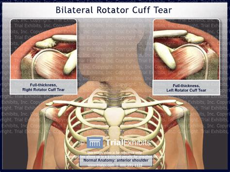 Bilateral Rotator Cuff Tear Trialexhibits Inc