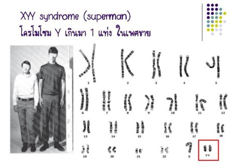 47 xyy syndrome pictures