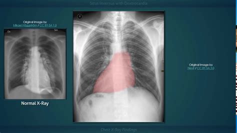 Situs Inversus With Dextrocardia Explanation Of Chest X Ray Findings