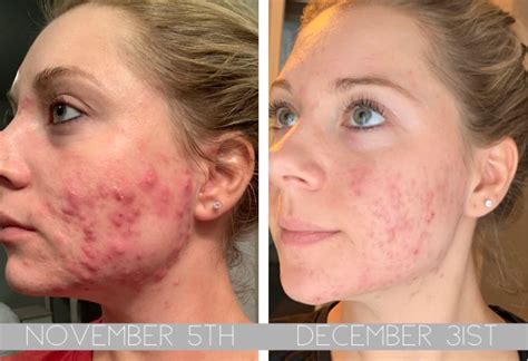 How To Get Rid Of Painful Cystic Acne — Mrs Kayla Durkin