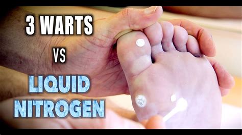 3 warts vs liquid nitrogen dr paul youtube