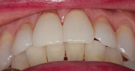 Tooth whitening is an easy, conservative, safe and cost effective way to whiten teeth. Splint for Posterior Open Bite | Elizabeth Caughey ...