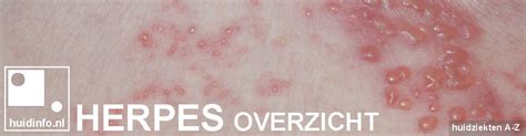 Baby und kleinkind häufig betroffen. HERPES SIMPLEX | overzicht van de dermatoloog | huidinfo ...