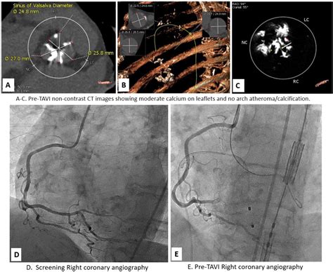 Peri Procedural Right Coronary Artery Occlusion By Calcium Embolus