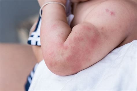 17 Most Common Types Of Baby Rashes With Pictures