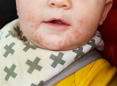 Rashes In Babies Types Symptoms And More 2023
