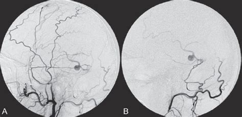 3 Cranial Dural Arteriovenous Shunts Radiology Key