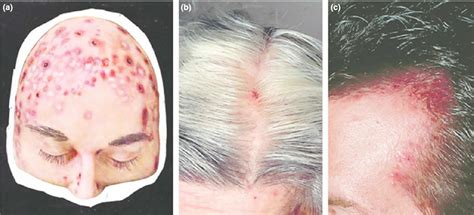 Acne Necrotica Definition Causes Symptoms Diagnosis And Treatment