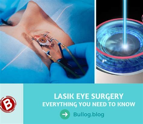 lasik eye surgery reviews 2019 archives bullog