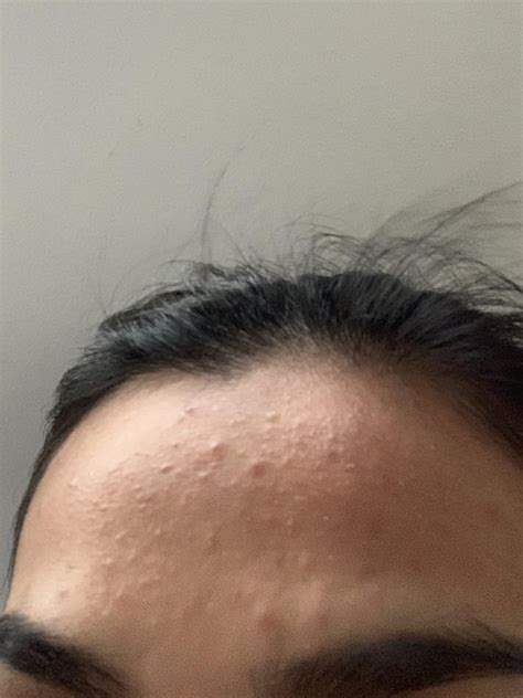 Using Curology For Months And Bumps On Forehead Suddenly Appeared Please Help R SkincareAddicts