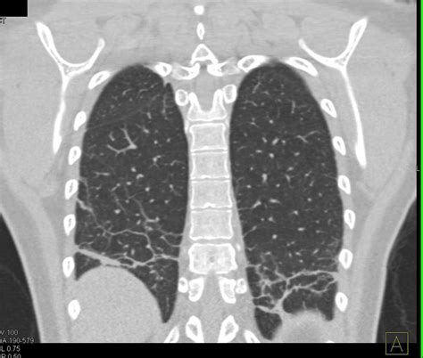 Increased Lower Lungs Markings Due To Hypoinflation Chest Case