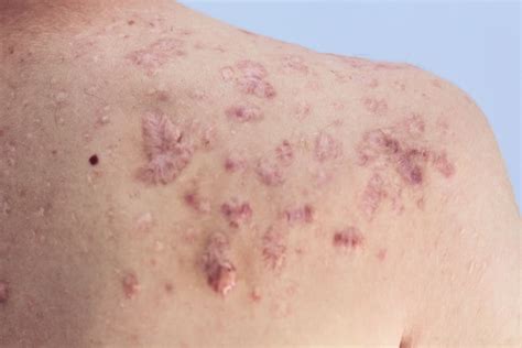 Back Acne Scars Bacne Treatment In Nyc Dr Michele Green Md