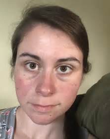 Skin Concerns Advice For Red Skin Not Rosacea Have Been Like This