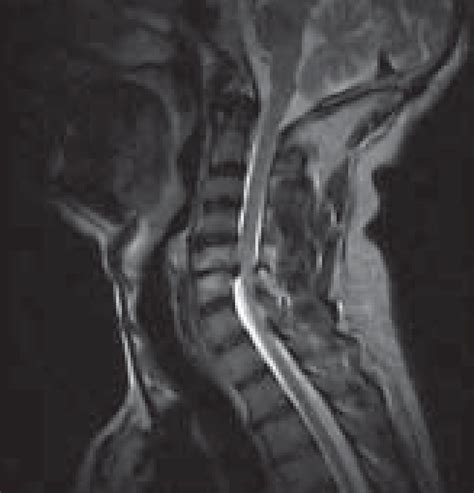 Mri Showing Cervical Disc Prolapse C5 6 And Hypertrophied Ligamentum