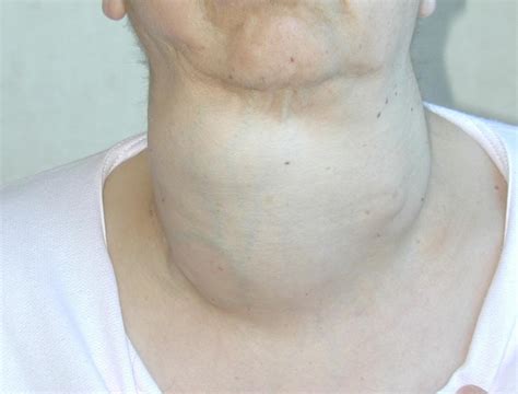 Emergency Total Thyroidectomy Due To Non Traumatic Disease Experience