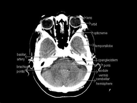 Ct Anatomy Head