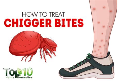 How To Treat Chigger Bites Top 10 Home Remedies