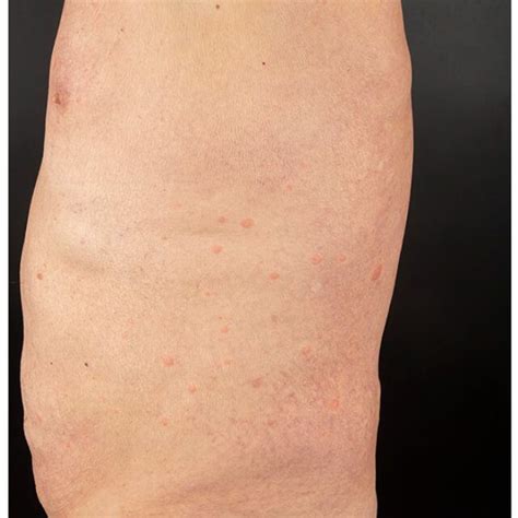 Multiple Edematous Erythematous And Well Demarcated Papules And