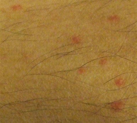 Flea Bites On Humans Symptoms Treatment And More Dengarden