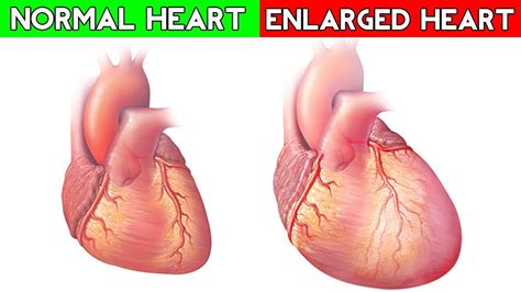 Enlarged Heart Causes Signs Symptoms Treatment