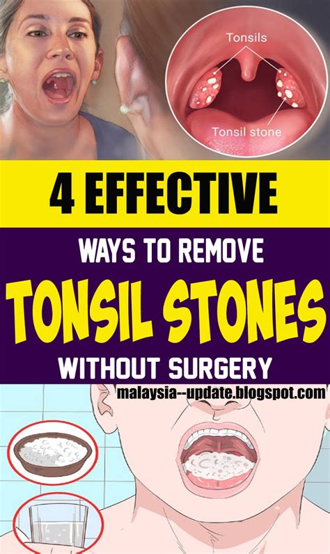 4 Effective Ways To Remove Tonsil Stones Without Surgery