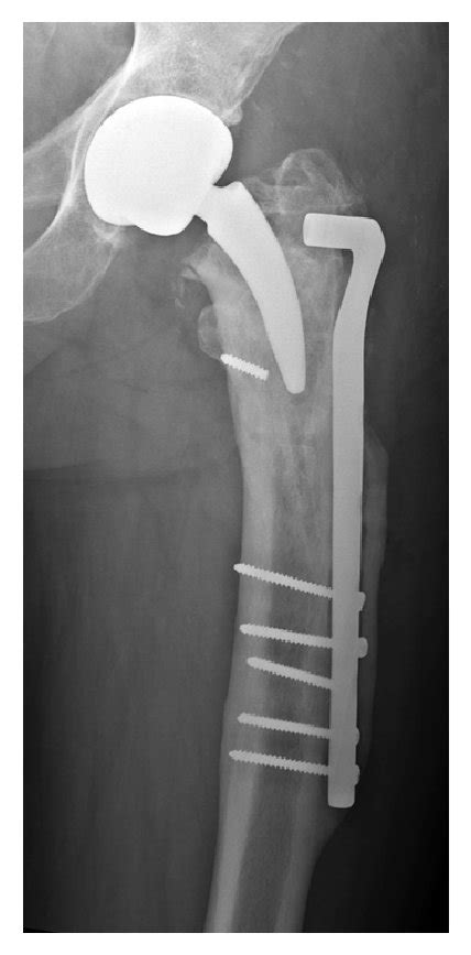 Anteroposterior A And Lateral B Radiographs Of The Left Hip One
