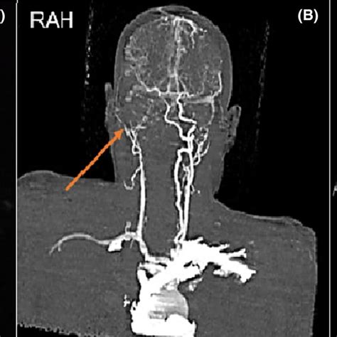 Magnetic Resonance Angiography Showing Occluded Right Proximal Internal