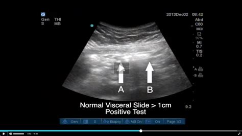 Negative Sliding Sign By Ultrasound In Repeat Cesarean Section Predicts