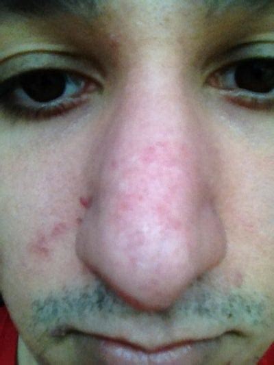 Scarring On Nose After Acne Photo Doctor Answers Tips