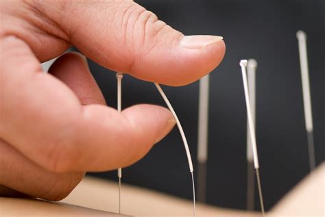 What Does Acupuncture Feel Like