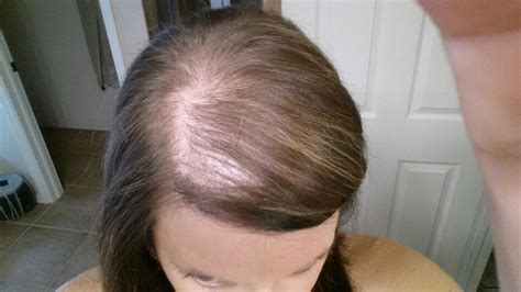 Postpartum Hair Loss Symptoms Causes Treatment Home Remedies