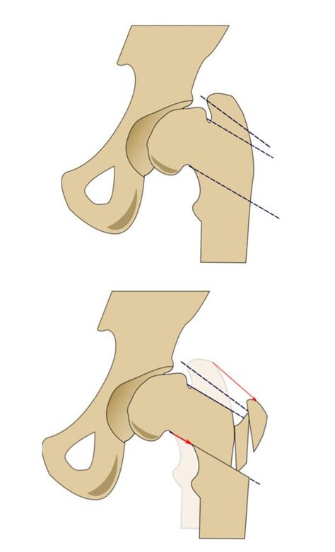 Morscher Osteotomy Cllc Montreal Dr Marie Gdalevitch