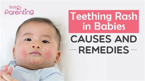 Teething Rash Drool Rash In Babies Causes Remedies And Prevention