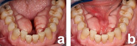 Mandibular Tori Interfering With The Mobility Of The Lingual Frenulum A Short Case Report