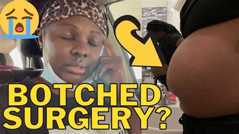 Deformed Stomach Did I Receive A Botched Surgery Post Op Appointment And Chik Fil A Youtube