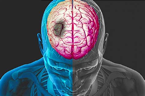 Accident Cerebral Ischemic Cauze Si Tratament Onlines Ro