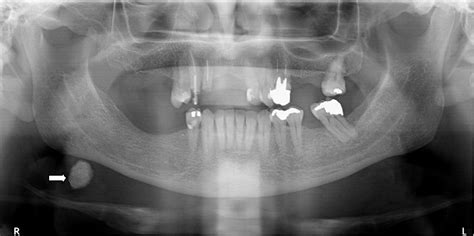 Panoramic Radiography — Diagnosis Of Relevant Structures That Might