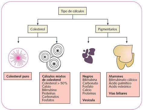 Patología vesicular Colelitiasis